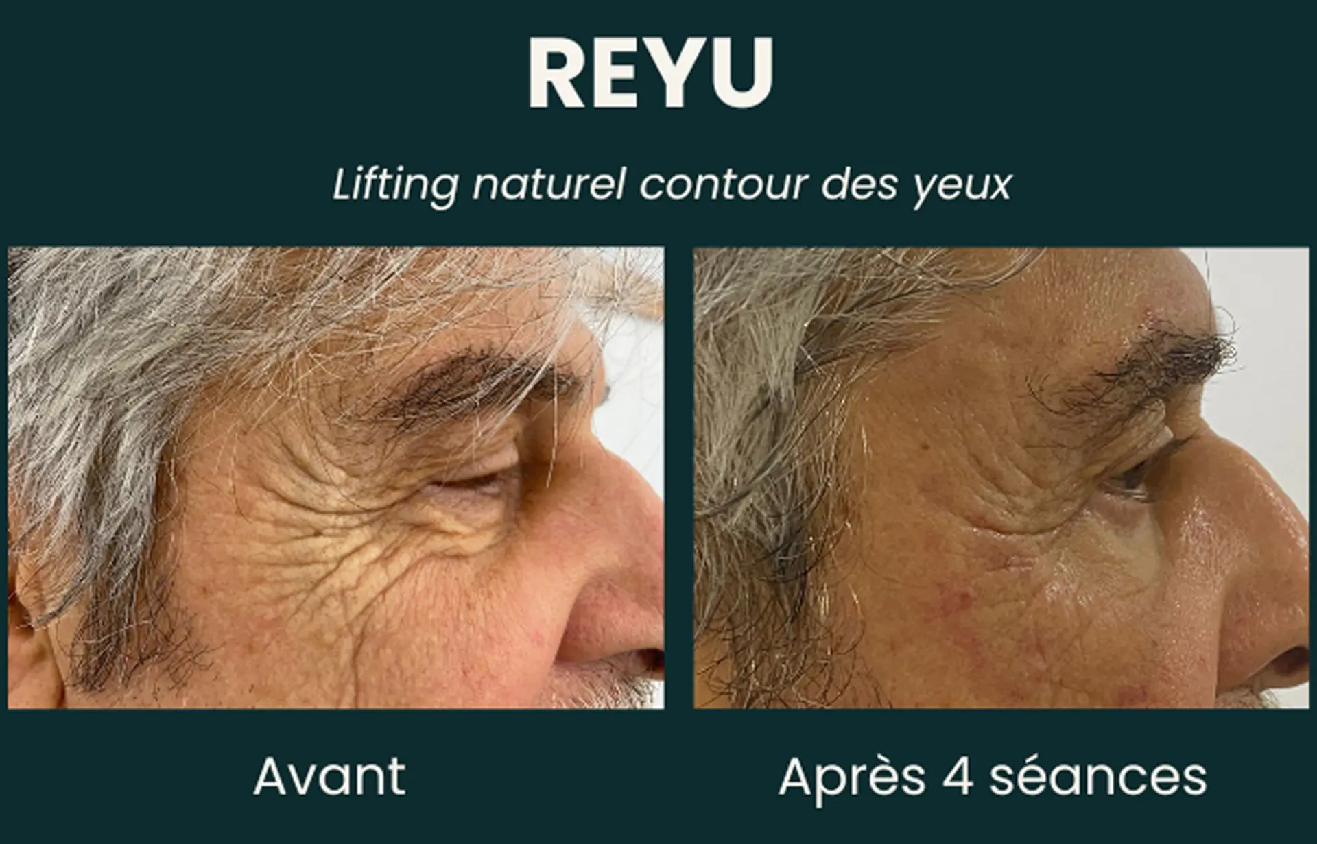Résultat avant et après quatre séances REYU sur le contour des yeux