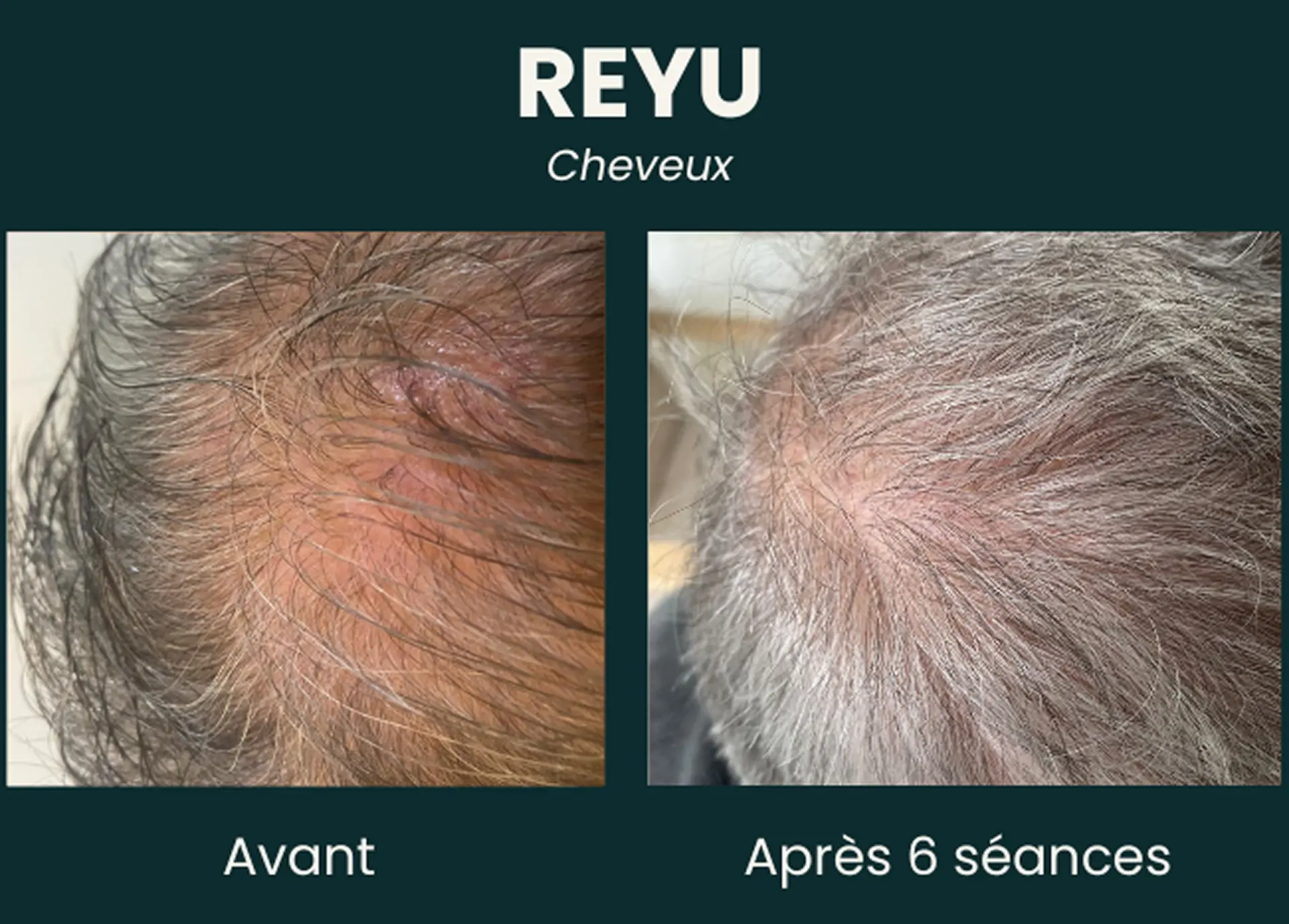 Résultat avant et après six séances REYU Cheveux