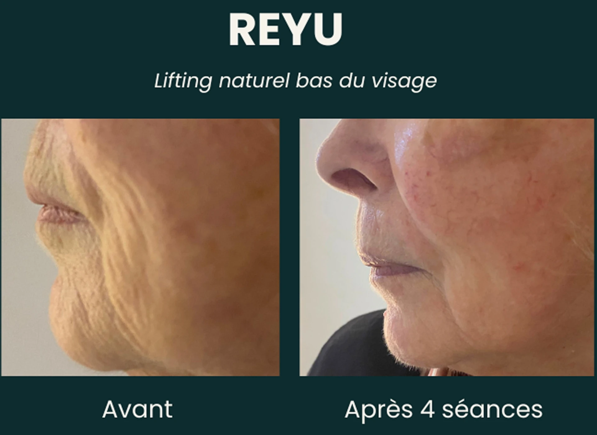 Résultat avant et après quatre séances REYU sur le bas du visage